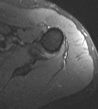 Figure 3 for case Tear of tendon of long head of biceps brachii sp tenodesis (RID1944)